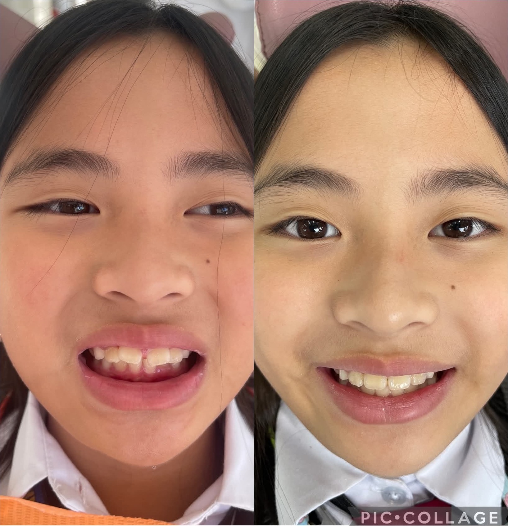 Integrated Endodontic & Veneer Restoration